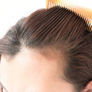 Laser Hair Therapy Vs Hair Transplant