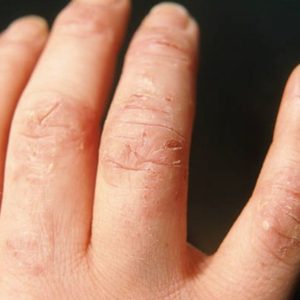 Can Use of Hand Sanitizer Damage my Skin? Answered!