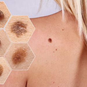 Warning Signs of Melanoma